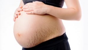How to Avoid Stretch Marks during Pregnancy