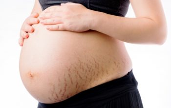 How to Avoid Stretch Marks during Pregnancy