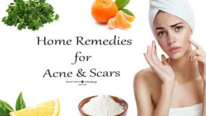 Home Remedies To Get Rid Of Acne - 10 Natural Acne Curing Tips
