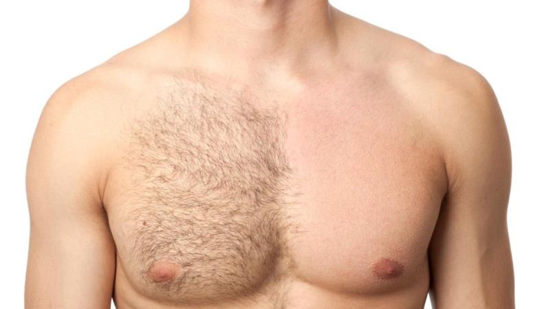 Chest Hair Elimination